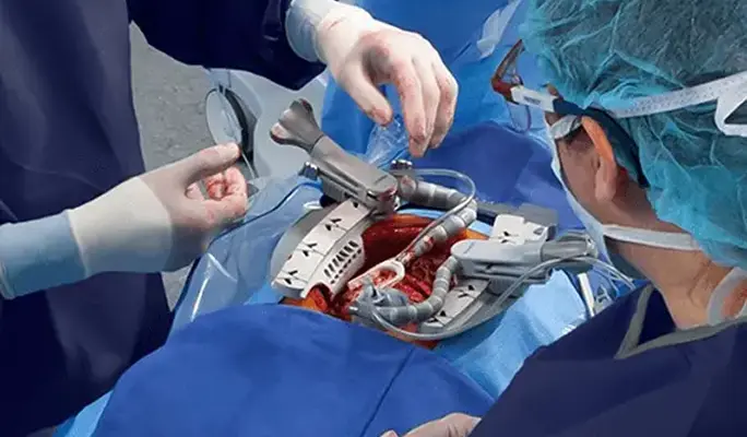 Cardiac Surgery Abroad